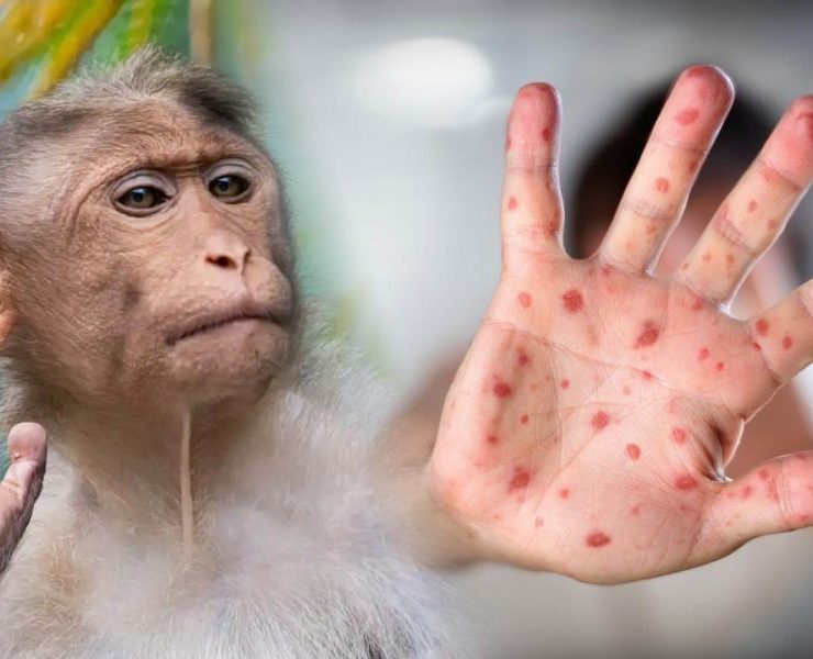 Veracruz registra primer caso de viruela del mono; hay 49 confirmados en México